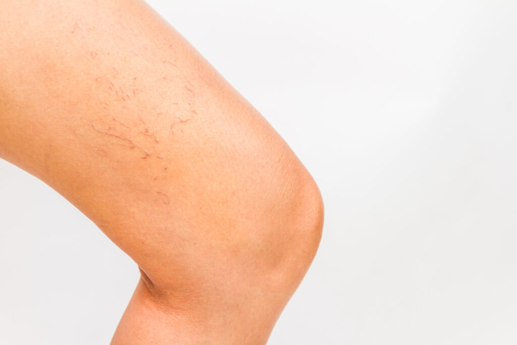 Varicose Veins McLean Dermatology & Skincare Center