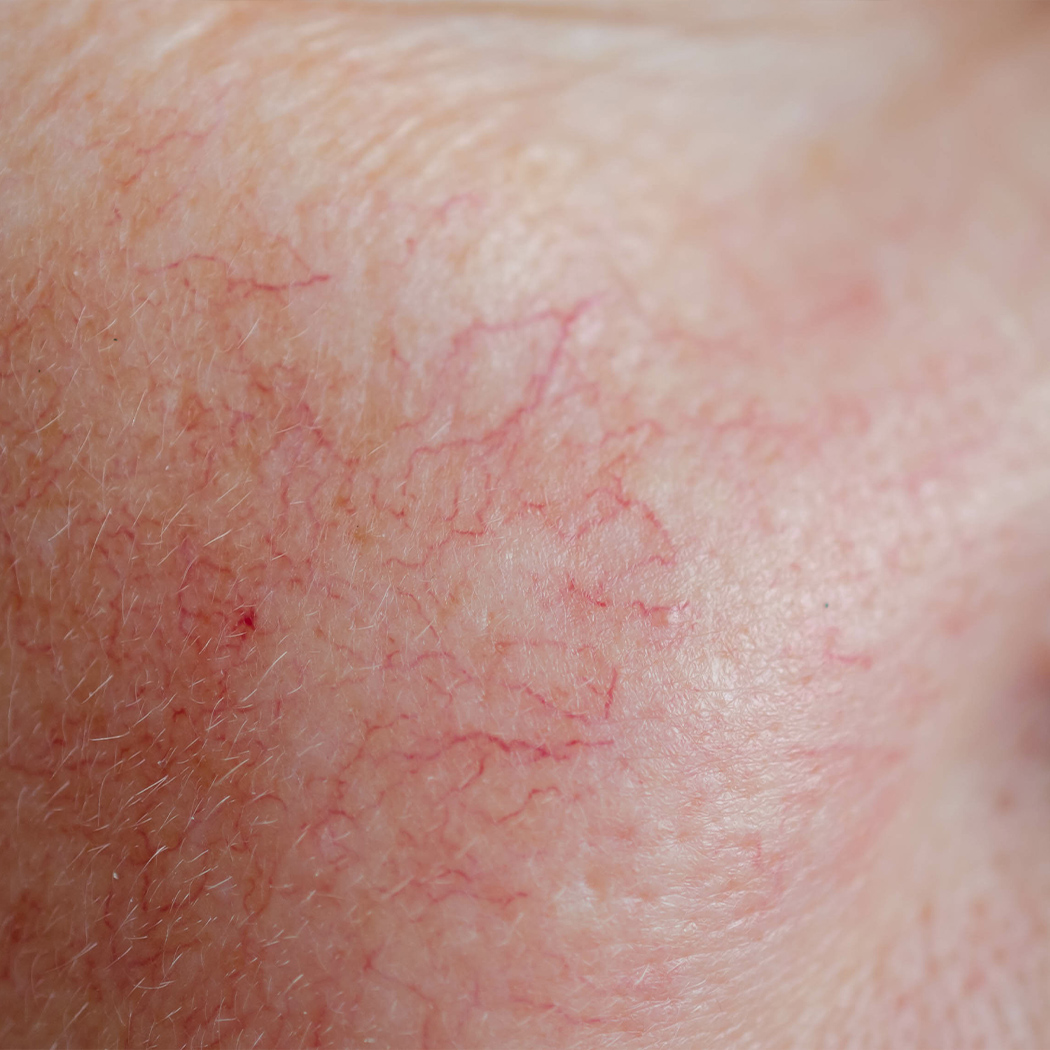 Broken Blood Vessels | McLean & Potomac Dermatology