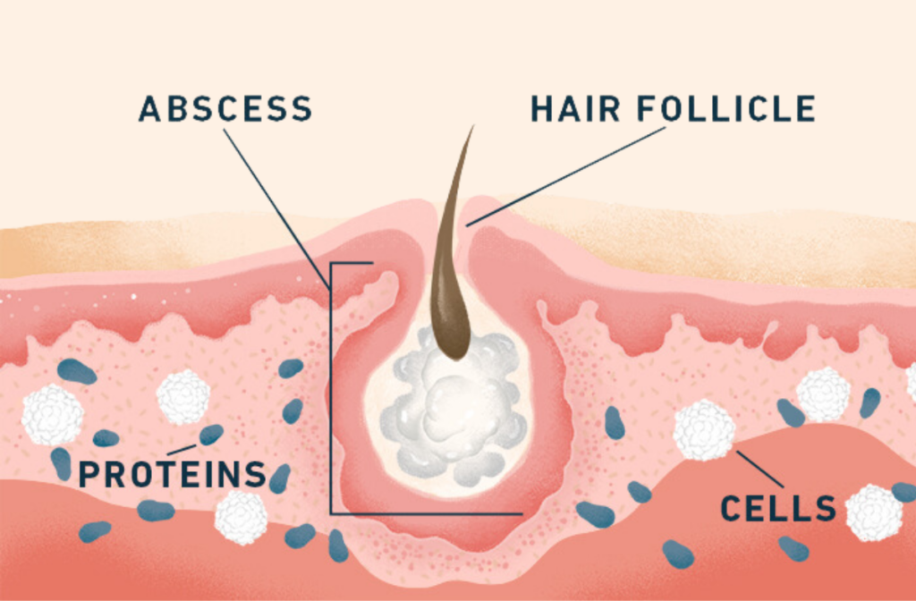 What To Know About Hidradenitis Suppurativa.