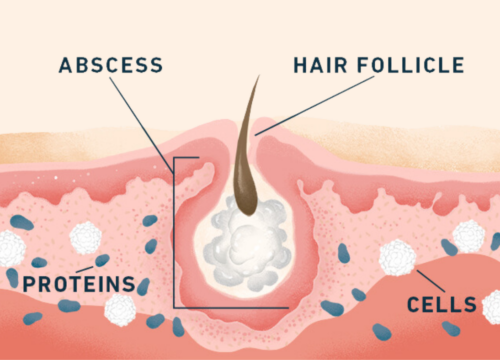 What To Know About Hidradenitis Suppurativa.