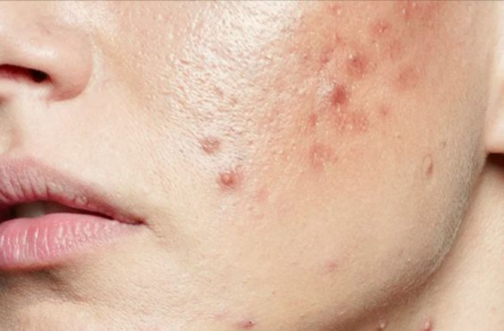 Poor Gut Health Could Be Causing Your Acne