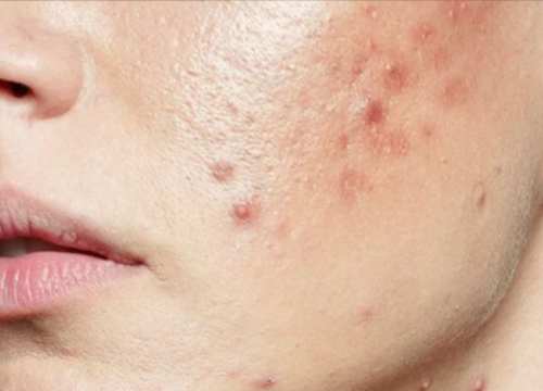 Poor Gut Health Could Be Causing Your Acne